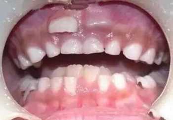 teeth teeth是几几年出的